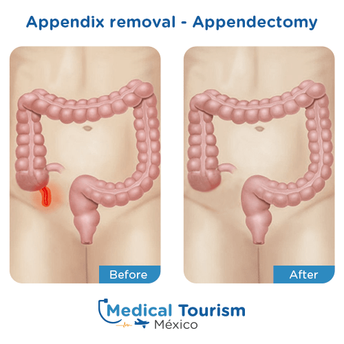 Illustrative image of Appendix removal